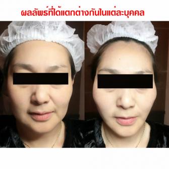 Before / After