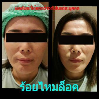 Before / After