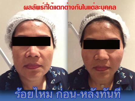 Before / After