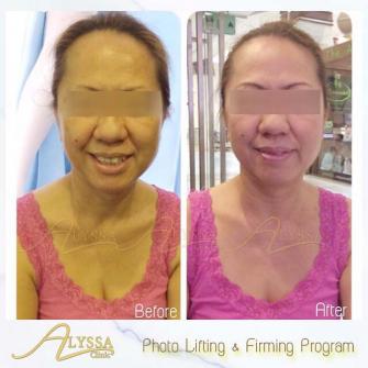 Treatment PLF